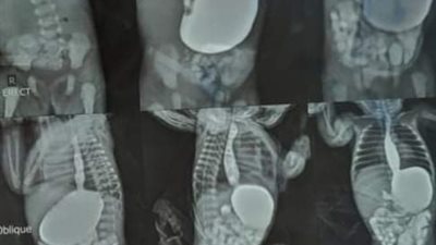 إجراء 3 جراحات لـ رُضّع داخل مستشفى ملوي التخصصي بالمنيا