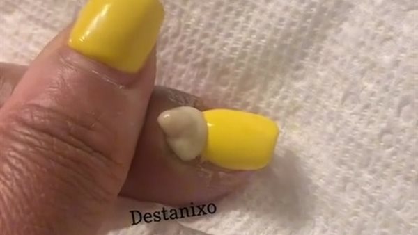 عدوى الأظافر