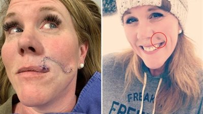 امرأة اعتقدت أن وحمة وجهها علامة جمال ولكنها كانت إنذارًا للإصابة بالسرطان 