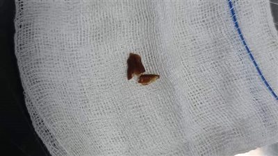 فريق طبى بمستشفى بنها الجامعي ينقذ حياة طفلة ابتلعت حبة لب خشابي 