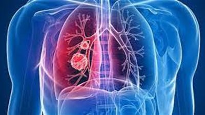  من بينها ضيق التنفس.. تعرف على أعراض مرض الحويصلات الهوائية