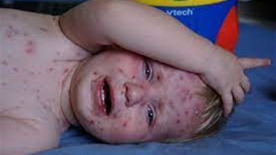 هل يمكن أن تصاب بجدري الماء مرتين؟