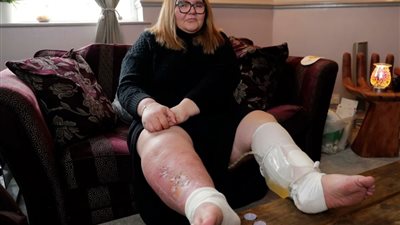 حشرة غامضة تتسبب في إصابة سيدة بقروح بالغة تغطي قدميها