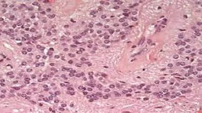 أكثر الأنواع انتشارًا.. تعرف على أعراض ورم البطاني العصبي عند الأطفال