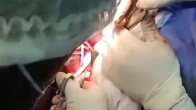 فريق طبي بأورام طنطا ينجح في استئصال ورم من سيدة 