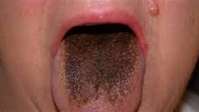  هندي يتحول لون لسانه للأسود بعد إصابته بسكتة دماغية