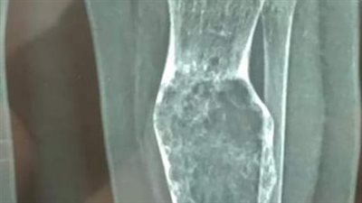 بواسطة جهاز الحفار.. نجاح جراحة دقيقة لرضيع بالتأمين الصحي ببورسعيد 