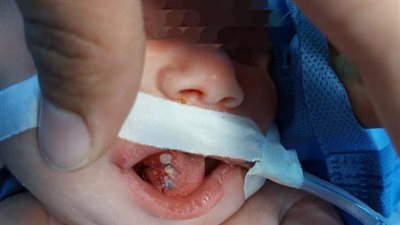 للمرة الأولى.. نجاح استئصال ورم من فم طفلة تبلغ ساعات بمطروح
