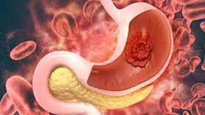 احذر.. تغير لون العين قد يكون من أعراض سرطان المعدة