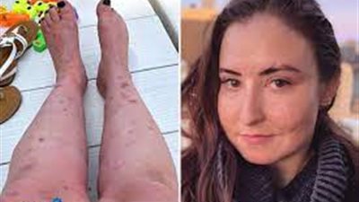  فتاة أمريكية تهدد ببتر ساقيها بسبب الوسواس القهري