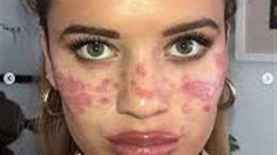 احذري.. فتاة أسترالية تصاب بالعمى المؤقت بسبب وشم النمش