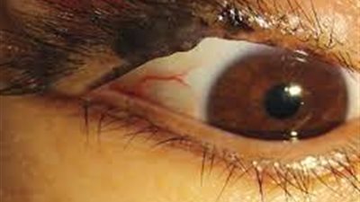 تورم وبقع حمراء..تعرف على أعراض سرطان الجلد الخطيرة في العيون