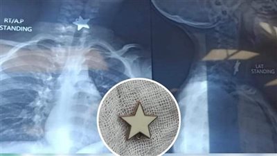 الرعاية الصحية: إنقاذ حياة طفل ابتلع قطعة معدنية بمستشفى المبرة في بورسعيد 