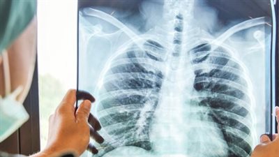 تزامنا مع اليوم العالمي له.. استشاري أمراض صدرية يضع روشتة وقائية لمرضى السل