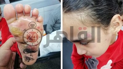 نجدة الطفل: النيابة العامة تحقق في واقعة تعذيب “جنة” على يد والدتها