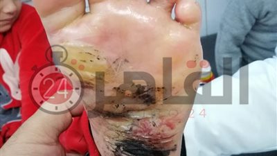 أول تحرك قانوني ضد والدة الطفلة “جنة” ضحية تعذيب والدتها في الدقهلية