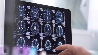 أمراض القلب الأكثر انتشارًا.. خبراء يكشفون عن عوامل خطيرة تسبب الإصابة بالخرف 