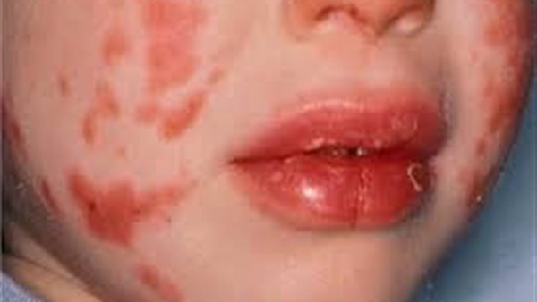 متلازمة كاواساكي