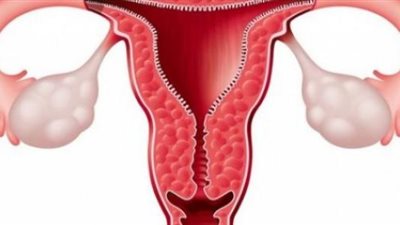 ارتفاع نسبة الإصابة بسرطان عنق الرحم لدى النساء فوق 30 سنة | دراسة