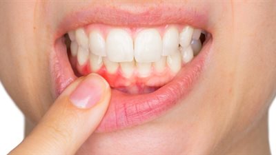 دراسة أمريكية توضح العلاقة بين تناول الكربوهيدرات وأمراض اللثة