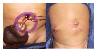 مستشفى مبرة طنطا ينجح فى إجراء جراحة دقيقة لجنين داخل رحم الأم 