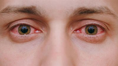 إحمرار العين يشير إلى الإصابة بأمراض خطيرة.. تعرف على التفاصيل