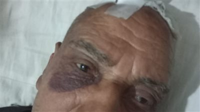 إصابة مسن ونجله بـ 35 غرزة خلال مشاجرة بالأسلحة البيضاء في المحلة بسبب قشرة موز 