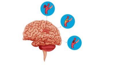 علماء يطورون علاجًا فعالًا لتمدد الأوعية الدموية في الدماغ