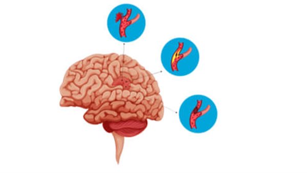 تمدد الأوعية الدموية