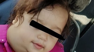 استئصال ورم من وجه طفل يزن 750 جراما بالإسكندرية 