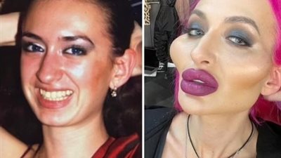 برغم الحرب.. الأوكرانية صاحبة أكبر خدود بالعالم تشارك متابعيها فيديو لعملية حقن في وجهها