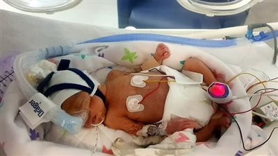 ميلاد طفل في الشهر السادس بوزن رطل.. والأطباء يضعونه في كيس بلاستيك لإبقائه على قيد الحياة