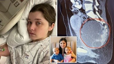  فتاة أمريكية تعاني من ورم يشبه رأس الطفل بعد مرور عدة أشهر من الولادة