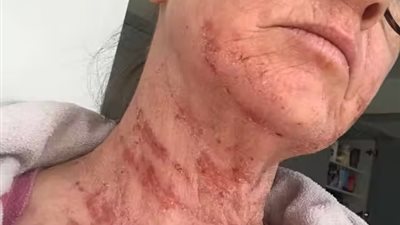 بسبب أعراض الانسحاب..بريطانية تعاني من تساقط الجلد بعد إدمانها علاج الإكزيما