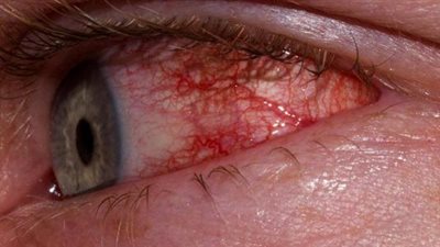 كيفية علاج التهاب العين بطرق منزلية بسيطة