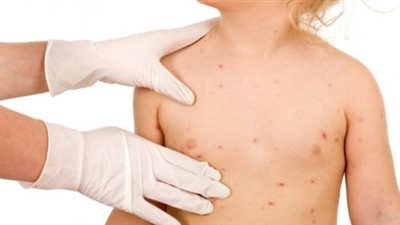 كيف تعالج طفلك من جدرى الماء في فصل الصيف؟