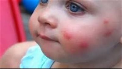 منها زيت النعناع.. تعرف على طرق تجنب لسعات البعوض والناموس