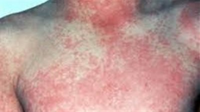 ليس لها علاج وتؤدي للوفاة.. أنواع وأعراض الحمى النزفية 