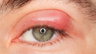 خبراء: جدري القرود يمكن أن يسبب التهاب الملتحمة 