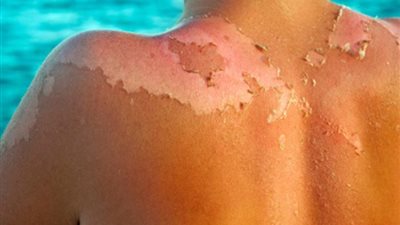 5 وسائل للوقاية من الأضرار الجلدية في فصل الصيف..منها الأحذية المفتوحة والابتعاد حمام الشمس