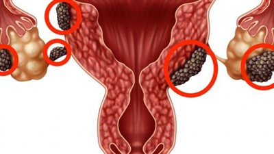 مع ارتفاع نسبتها عند النساء.. ما هي الأورام الليفية؟