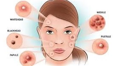 منها الرؤوس السوداء والخراجات.. تعرف على أنواع الحبوب وعلاجها