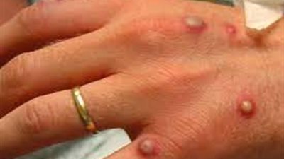 أبرزها الوجه والأعضاء التناسلية.. استشاري مناعة يوضح مراحل عدوى جدري القرود وأماكن ظهوره