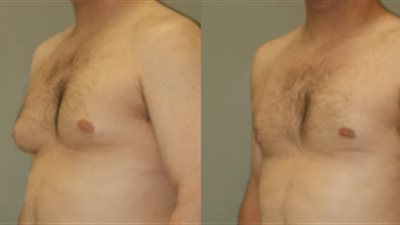 ما الأمراض التي يكشف عنها التثدي عند الرجال؟