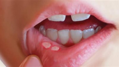 5 أمراض خطيرة ناتجة عن انتشار البقع البيضاء بالفم