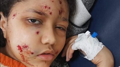 مصرع طفلة أصيبت بطلق خرطوش أثناء مشاهدة فرح من بلكونة منزل ببورسعيد 