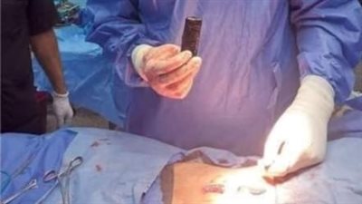 وزنه مابين 12_ 15 كيلو جرام.. فريق طبي يستأصل ورمًا من مسن بمستشفى بنها الجامعي