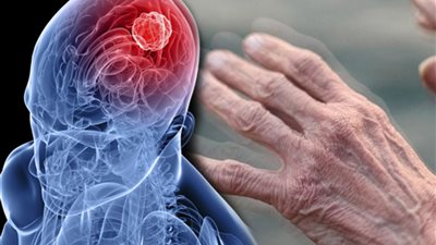 علماء: الكوابيس علامة مبكرة على الإصابة بمرض باركنسون