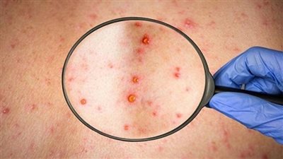جدري القرود وطرق العدوى.. 7 أعراض تدل على الإصابة 