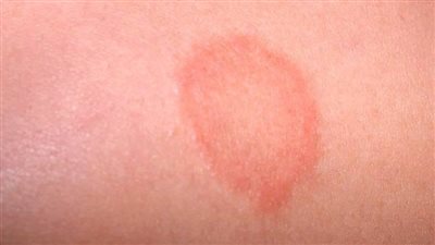 أستاذ جلدية: البشرة البيضاء أكثر تعرض لسرطان الجلد من السمراء